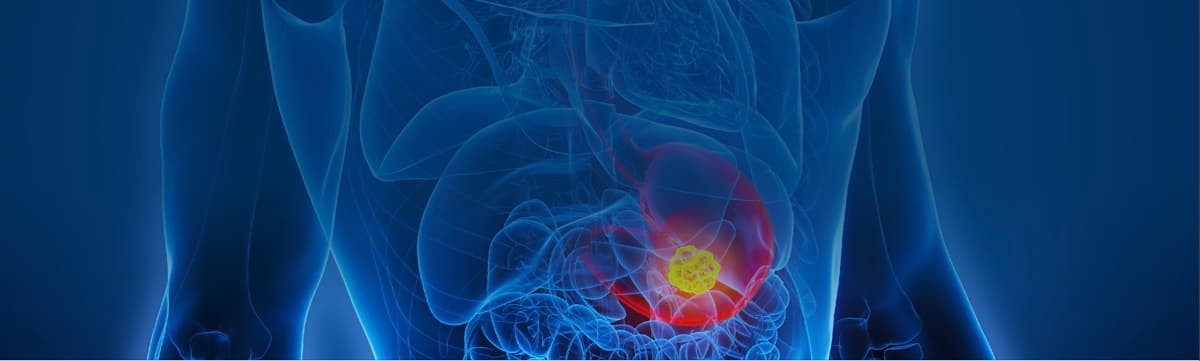 Gastrointestinal Cancers