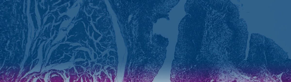 Gynecologic Cancers